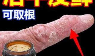 治疗疥疮最好的药膏